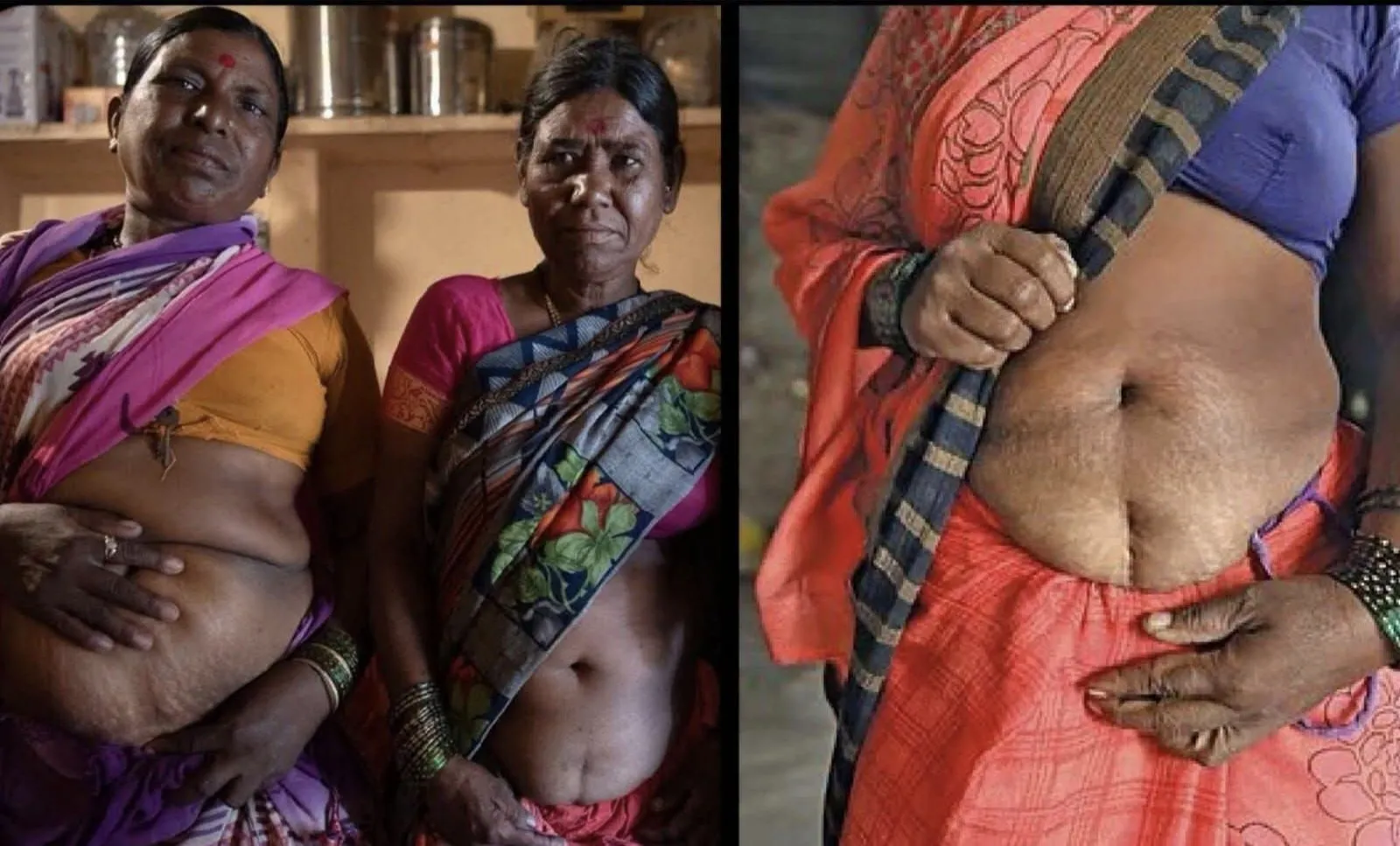 Women are having their uteruses removed to ensure their daily wages are not lost