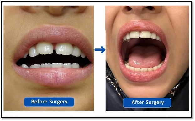 Seven-Year-Old Girl Regains Jaw Movement After Complex Surgery at AIIMS Jammu